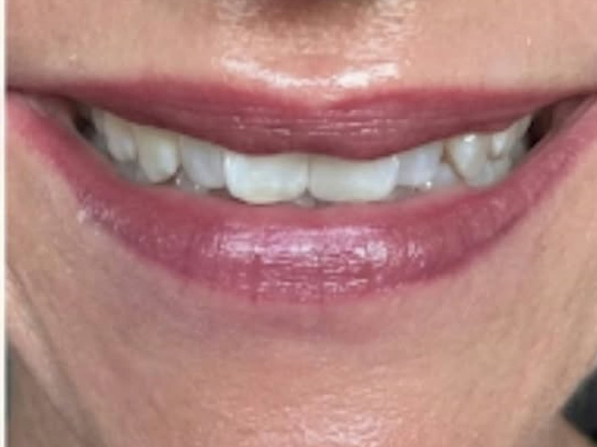 Lippen nach der Pigmentierung, natürlich verschönert